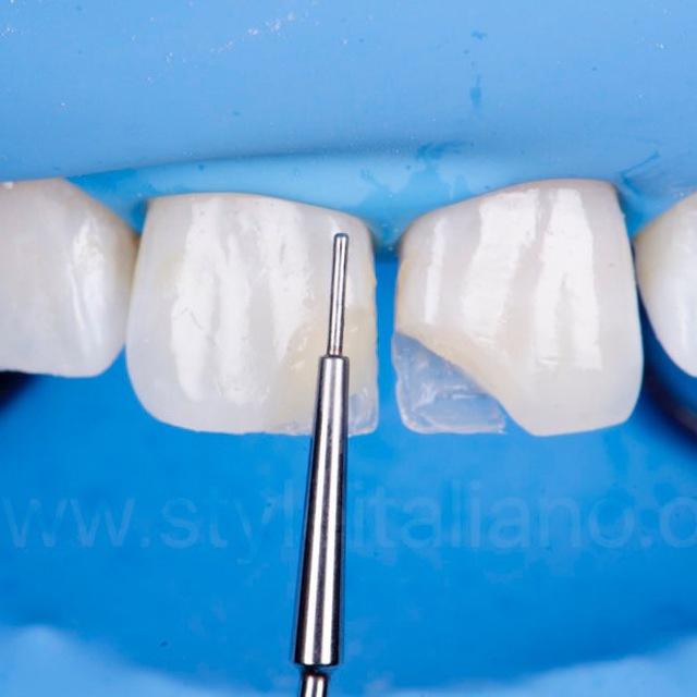 Anterior Composite
