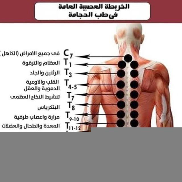 Cupping الحجامة