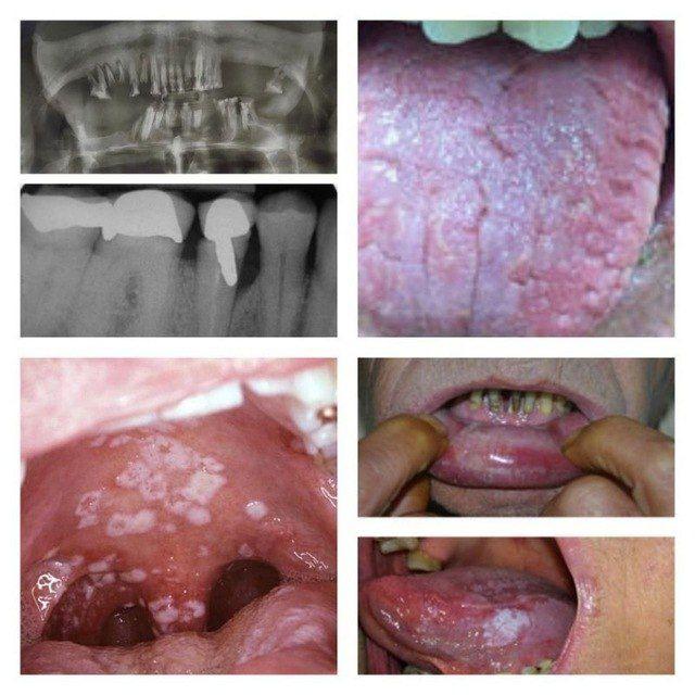 🦷عرض حالات سريريه ومناقشتها 🦷