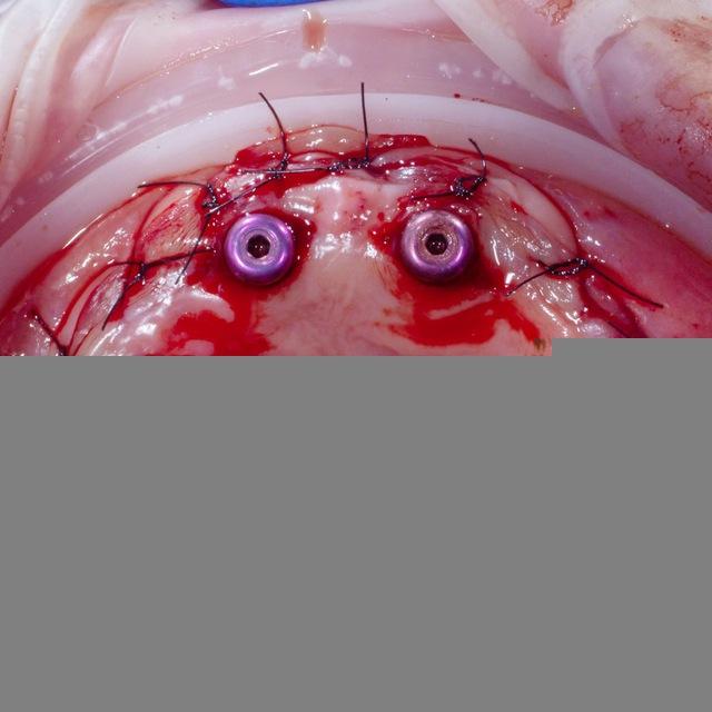 Basic oral surgery